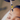 Hyperpigmentation