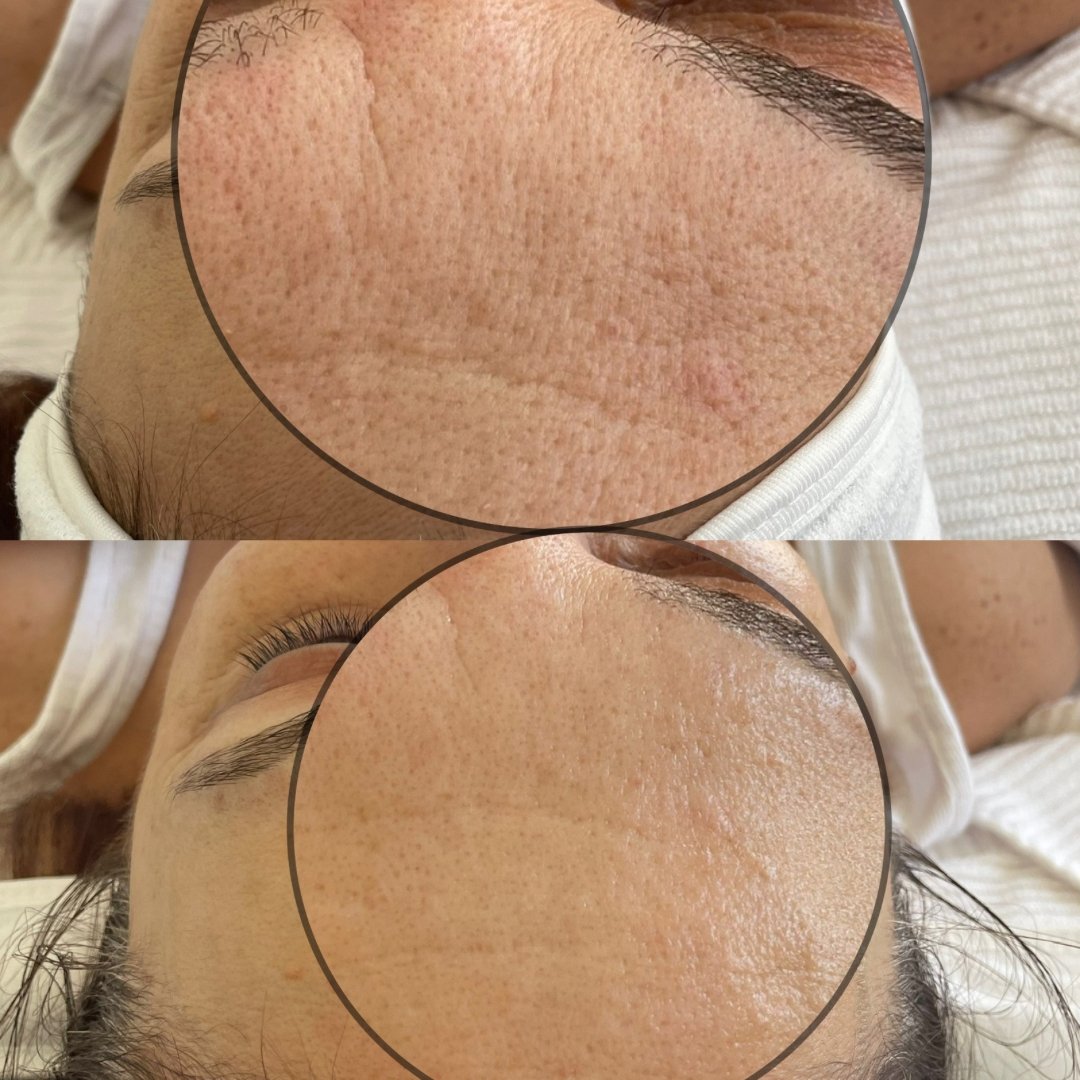 KrX CO2 Carboxy Therapy - by Kin Aesthetics