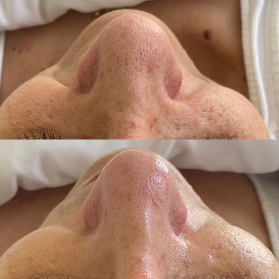 KrX Carboxy | Kin Aesthetics