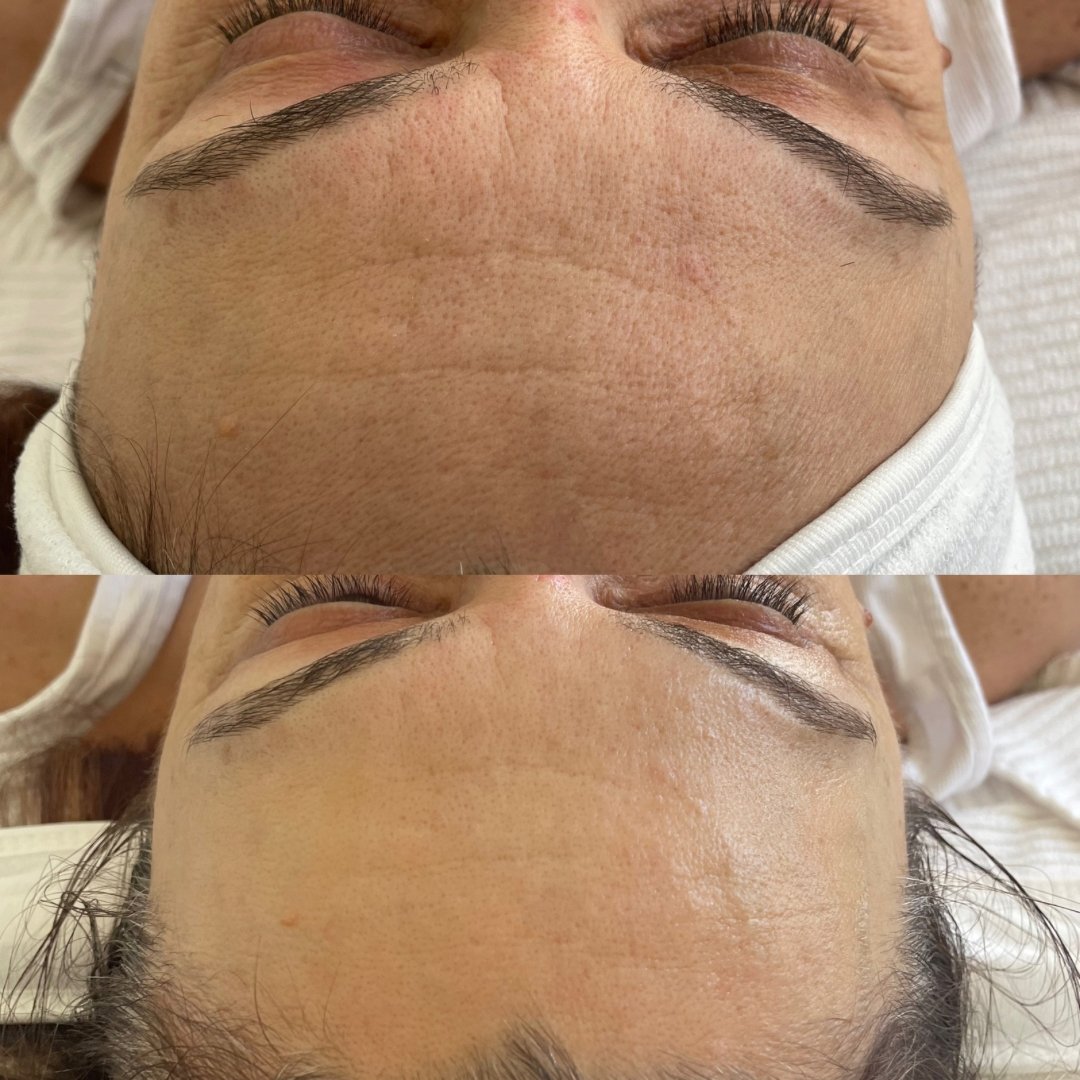 KrX CO2 Carboxy Therapy - by Kin Aesthetics