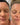 KrX CO2 Carboxy Therapy - by Kin Aesthetics