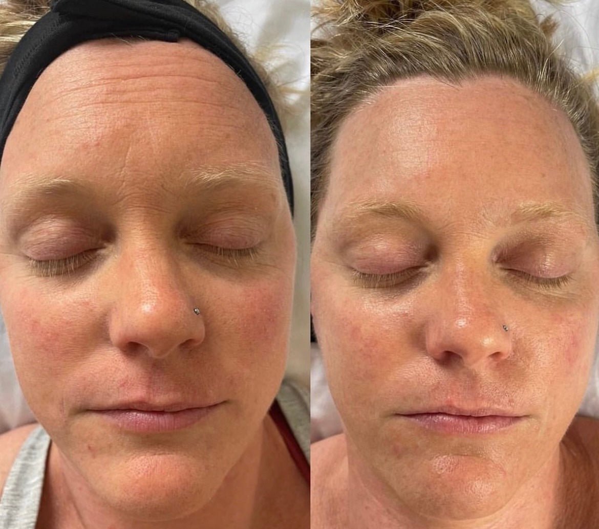 KrX CO2 Carboxy Therapy - by Kin Aesthetics