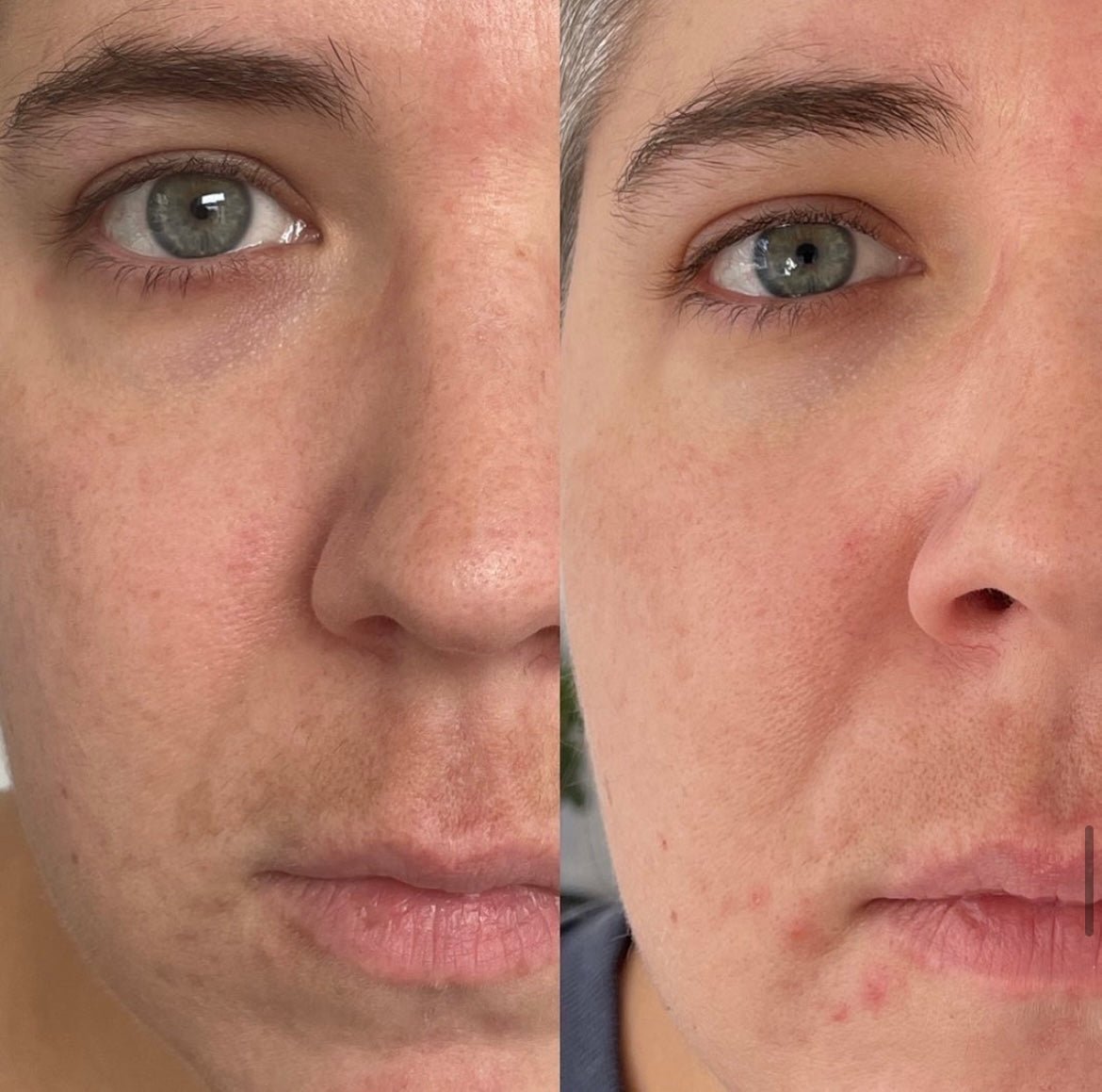 KrX Lazer Peel - by Kin Aesthetics 