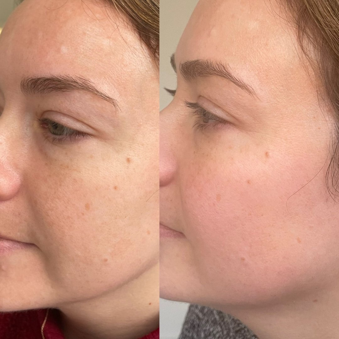 KrX Lazer Peel - by Kin Aesthetics 