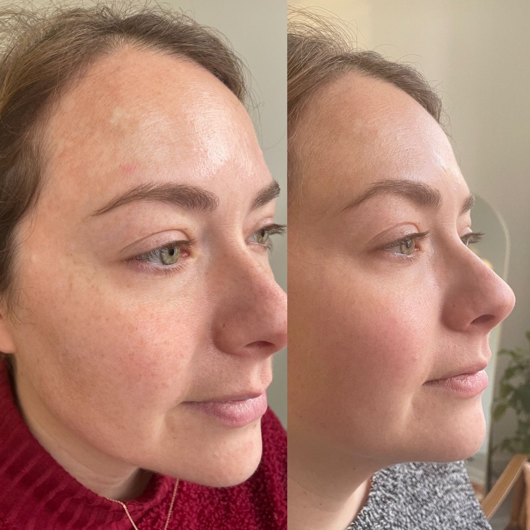 KrX Lazer Peel - by Kin Aesthetics 