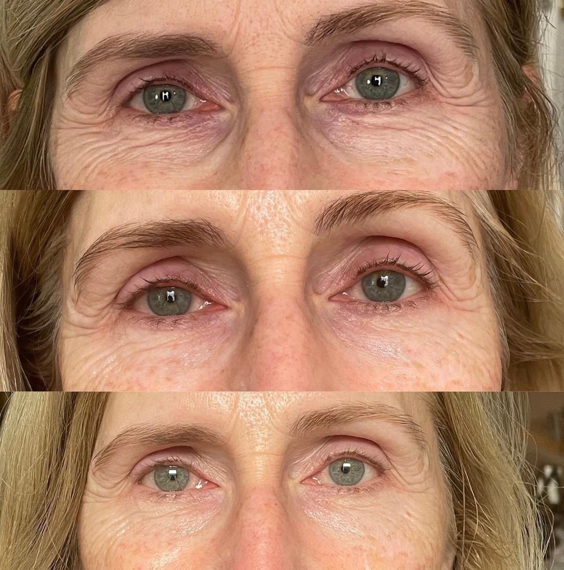 KrX Ultra V Lift - by Kin Aesthetics 