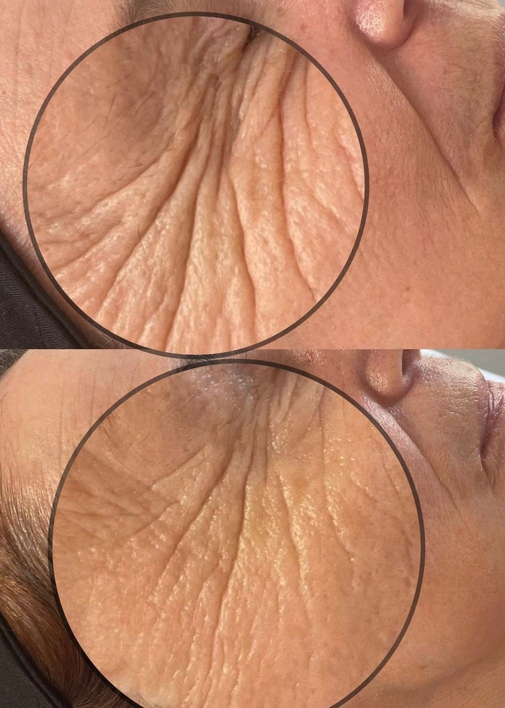 KrX Ultra V Lift - by Kin Aesthetics 