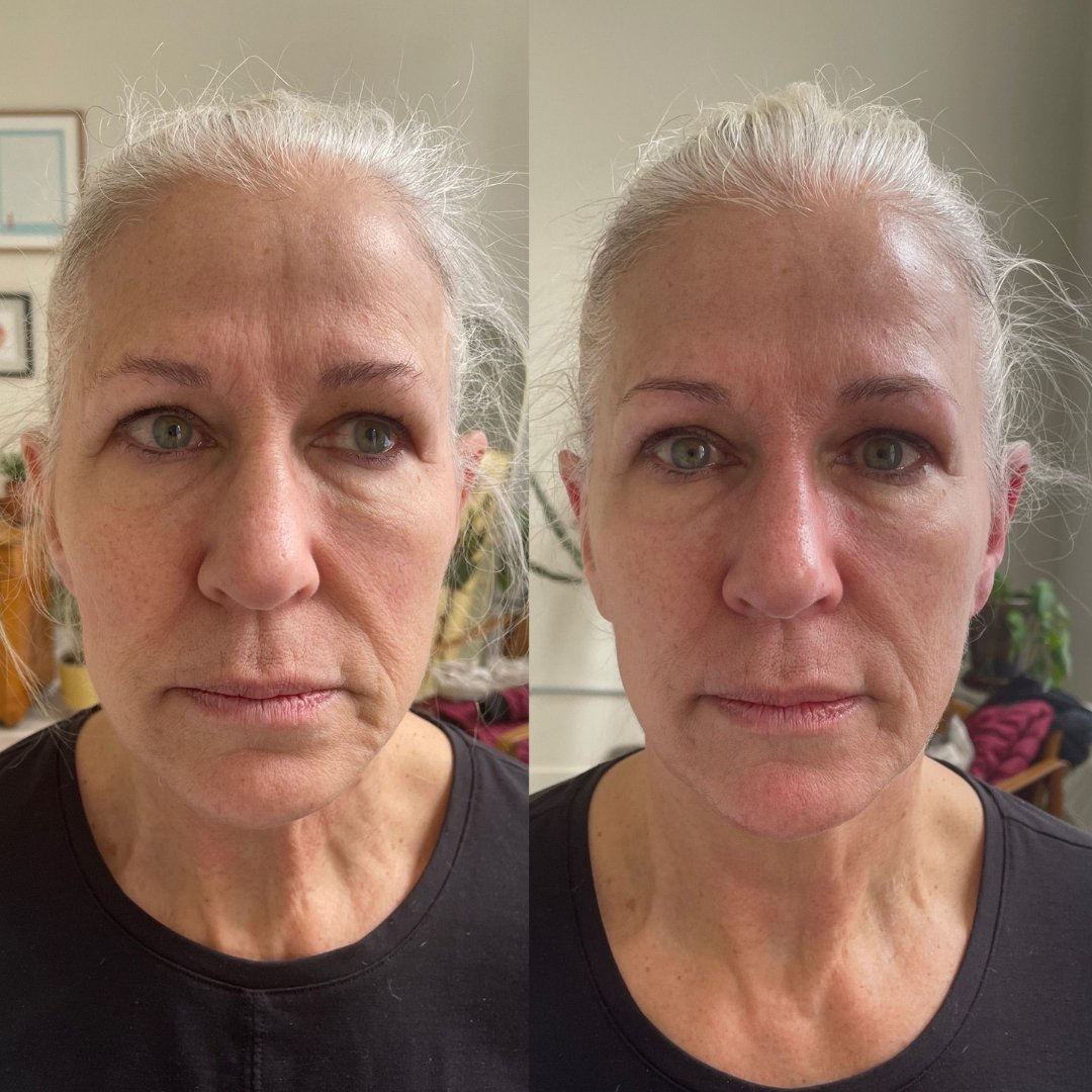 KrX Ultra V Lift - by Kin Aesthetics 