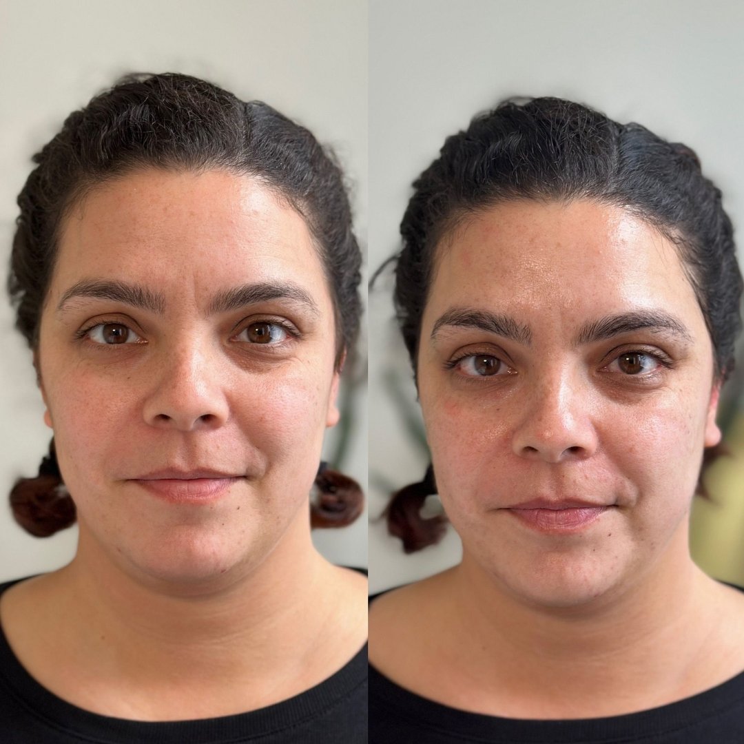 KrX Ultra V Lift - by Kin Aesthetics 